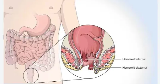 FAKTOR RISIKO & KOMPLIKASI BILA HEMOROID TIDAK DITANGANI