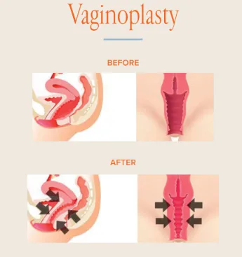 MANFAAT VAGINOPLASTY