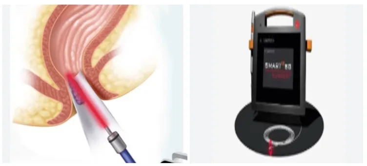 Hemoroid: Penyebab, Gejala, Pengobatan, hingga Tindakan Laser