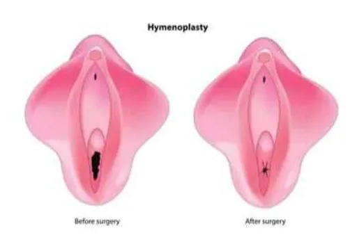 Hymenoplasty: Pengertian, Prosedur, Biaya, dan Perawatan Pasca Operasi