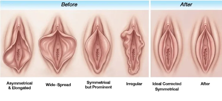 Labiaplasty: Pengertian, Alasan, Prosedur, Hasil, dan Perawatannya