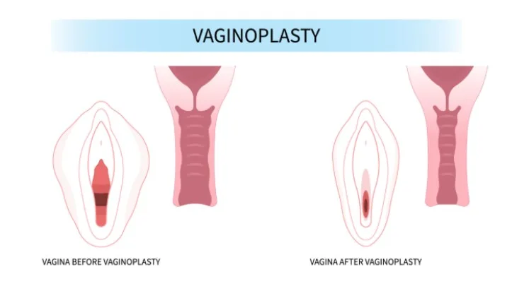 Vaginoplasty Pengertian, Indikasi, Manfaat, Prosedur, dan Pemulihan