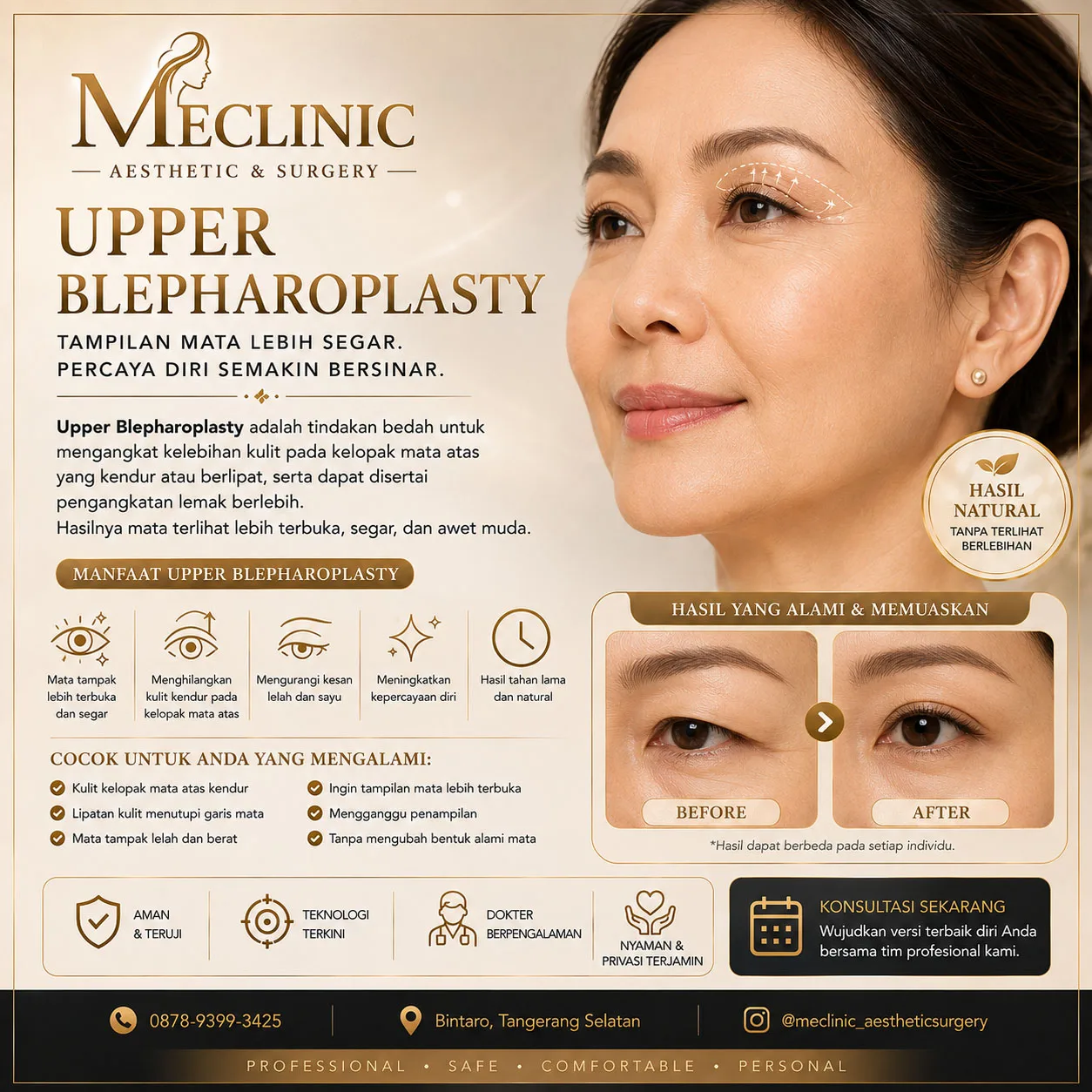 Upper Blepharoplasty
