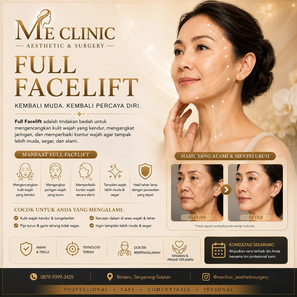 Full Facelift