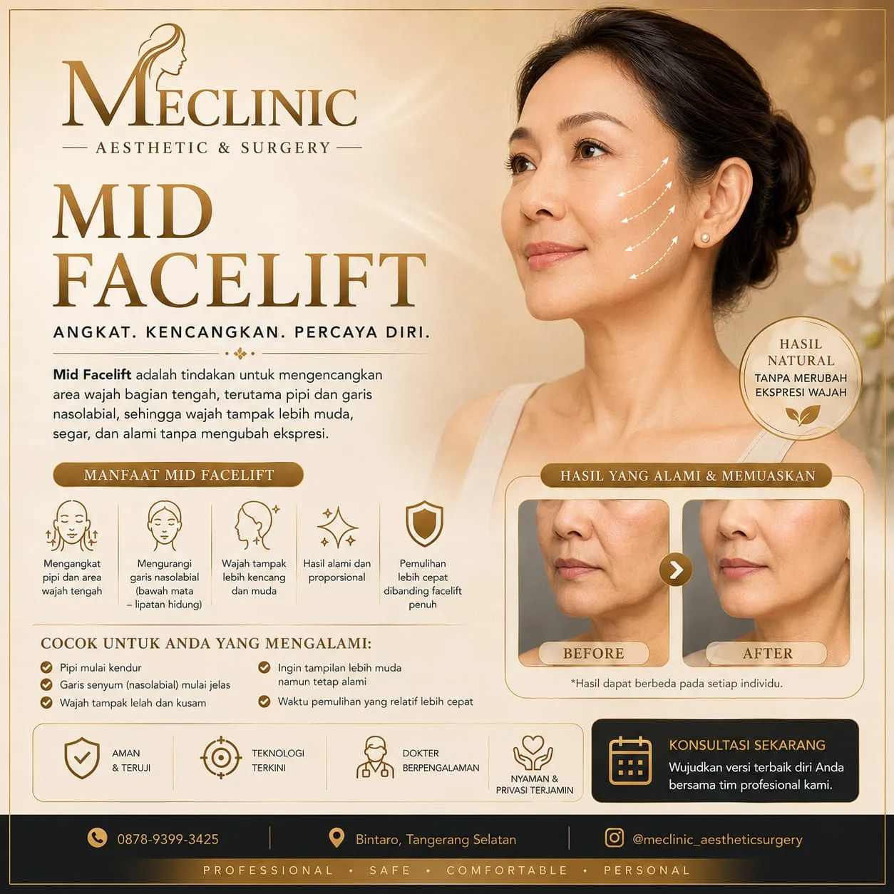 Mid Facelift