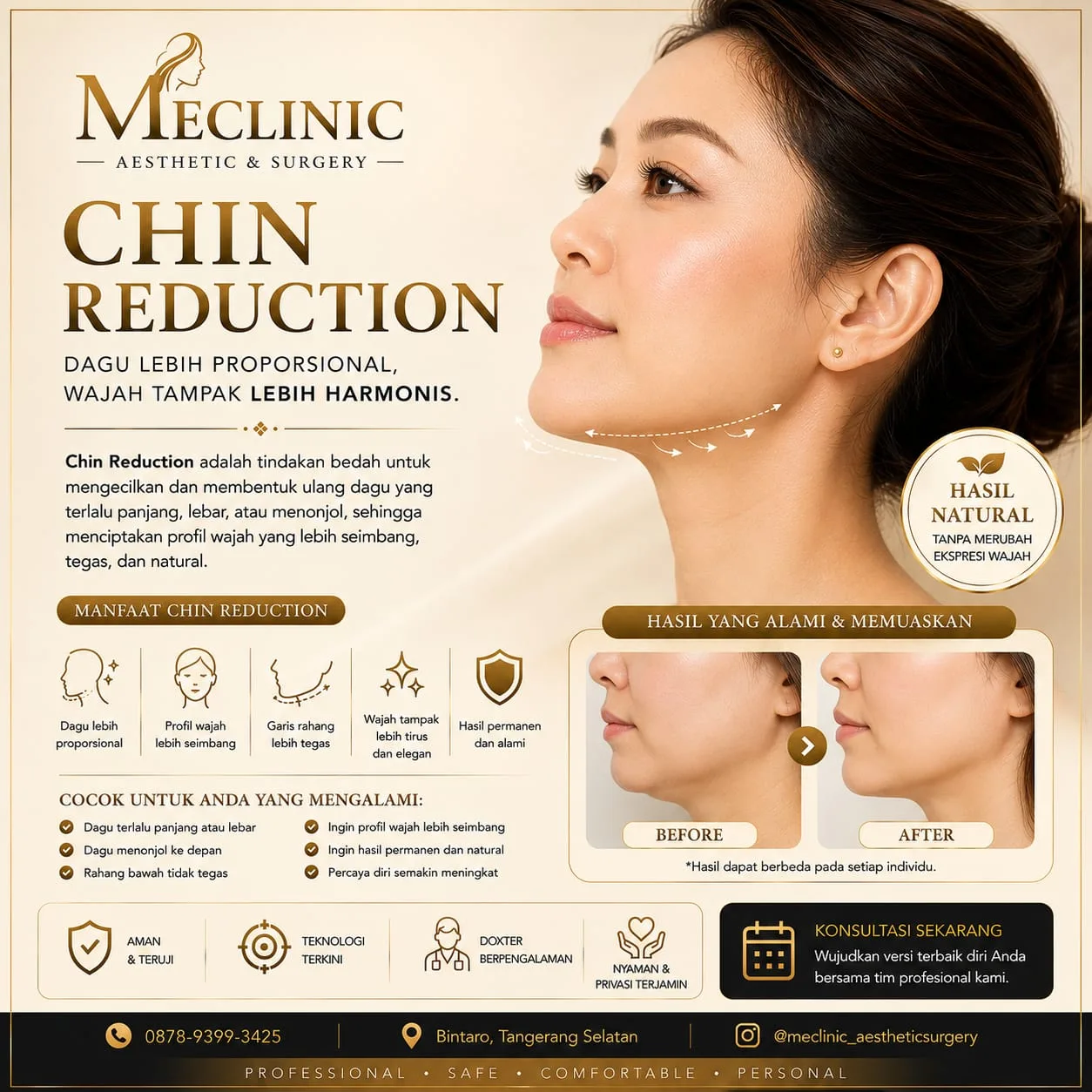 Chin Reduction