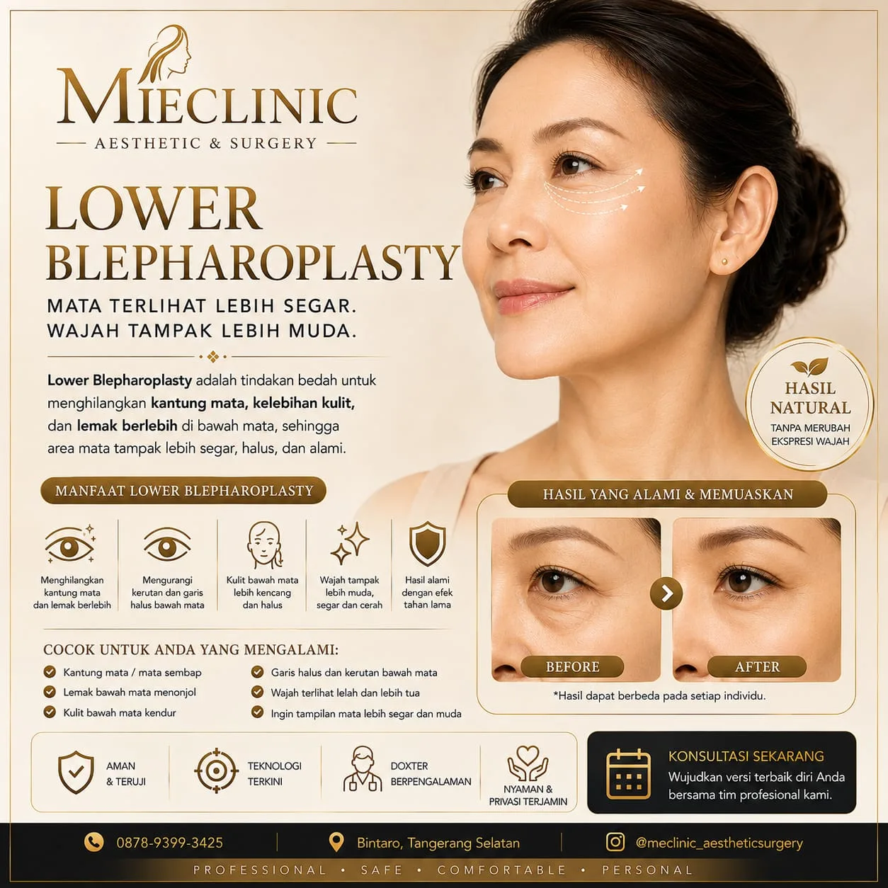 Lower Blepharoplasty